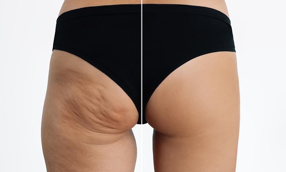 non-surgical-cellulite-wrinkles
